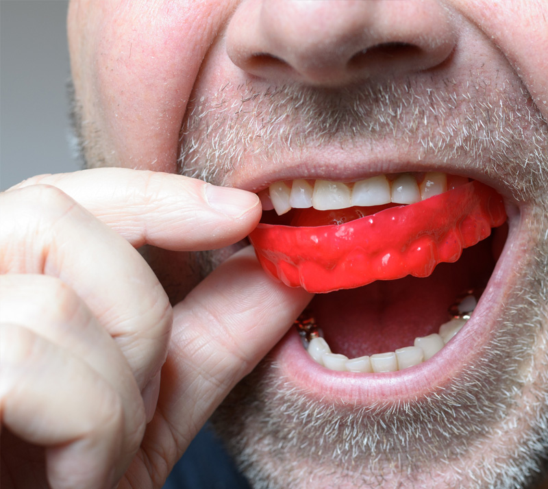 sports mouth guards in north london