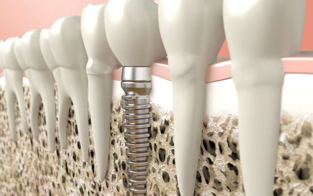 How Dental Implants Replace Everything You’ve Lost