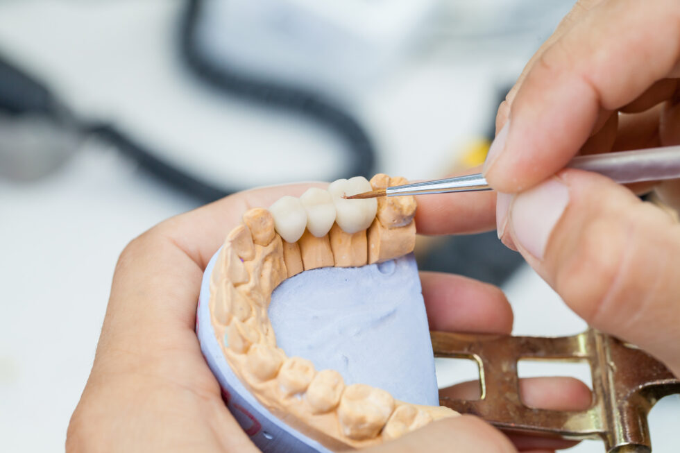 Dental Bridges: Four Things You Should Know
