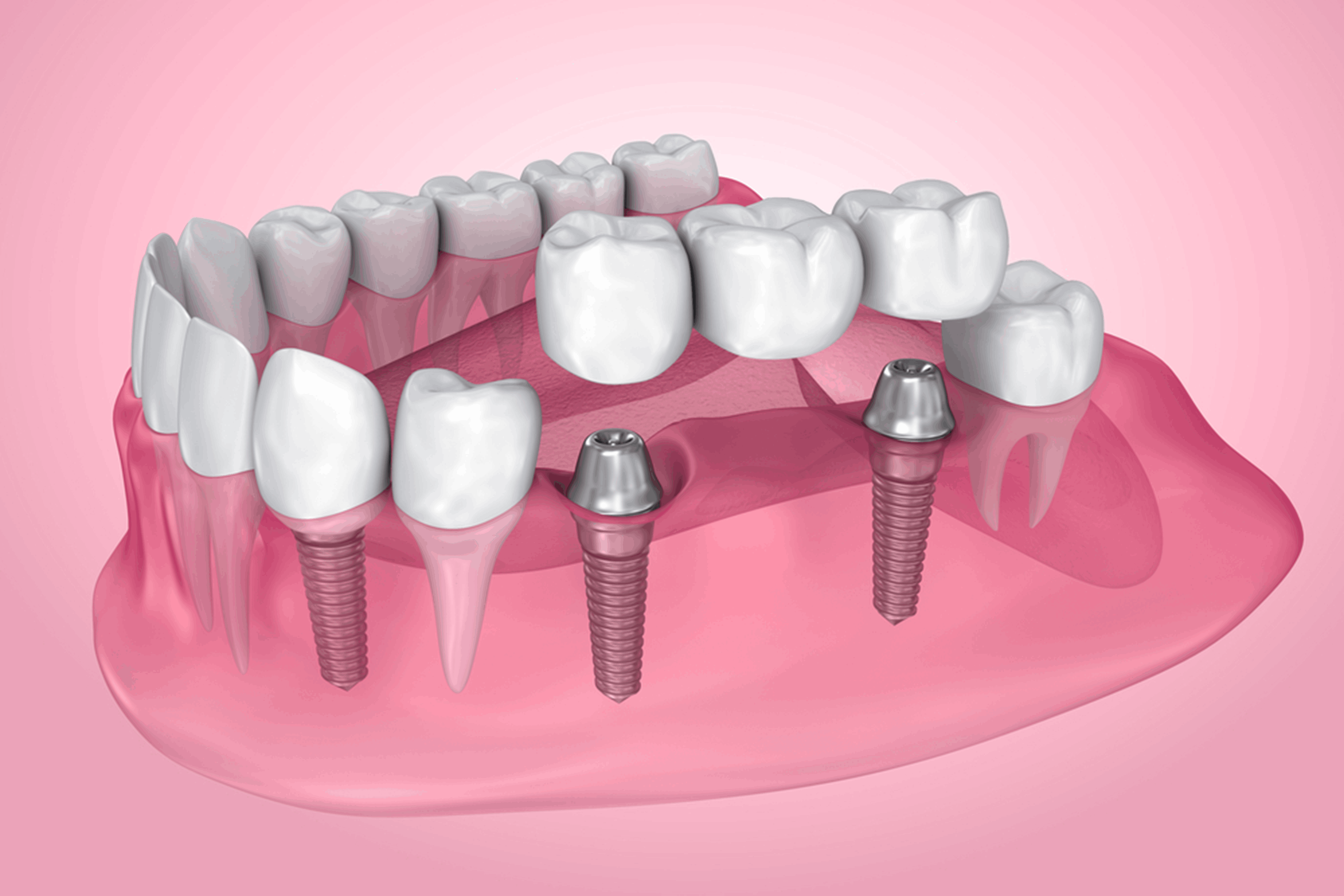 Types of Dental Bridges & Why You Need Them - Wharncliffe Dental