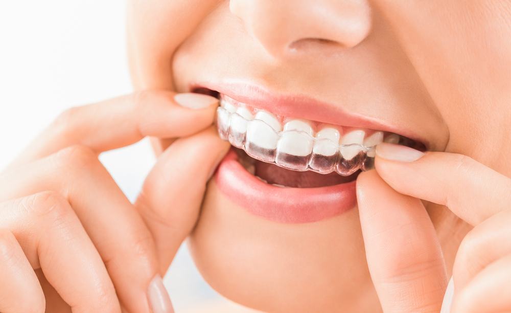 7 Key Facts About Invisalign Attachments You Should Know
